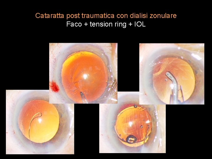 Cataratta post traumatica con dialisi zonulare Faco + tension ring + IOL 