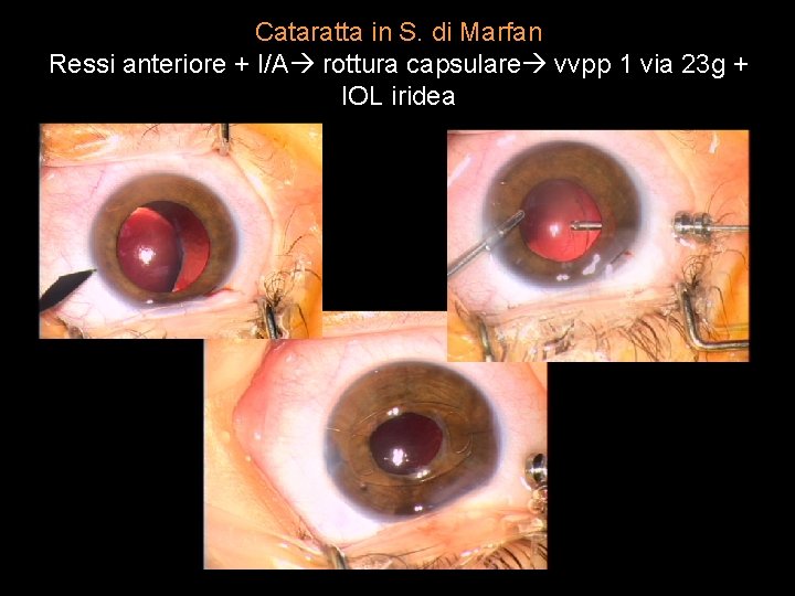 Cataratta in S. di Marfan Ressi anteriore + I/A rottura capsulare vvpp 1 via