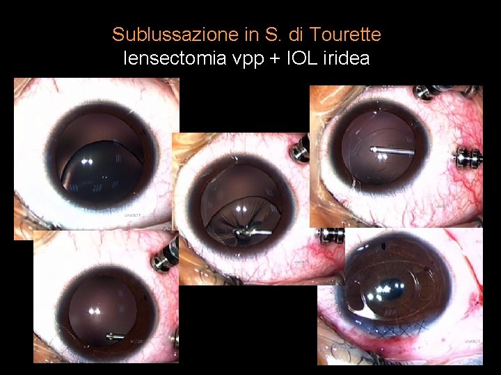 Sublussazione in S. di Tourette lensectomia vpp + IOL iridea 