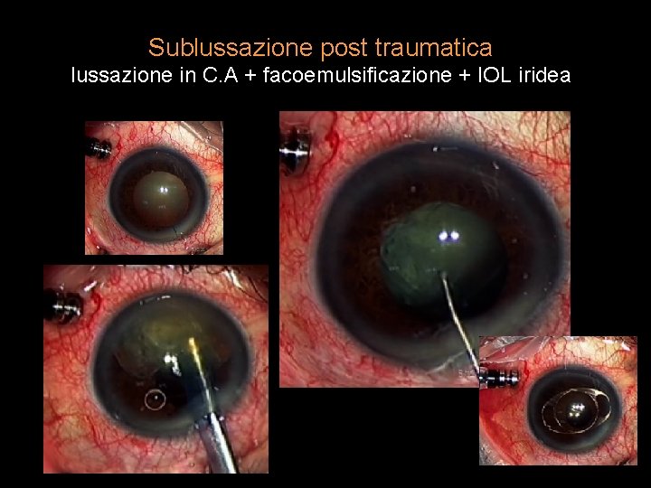 Sublussazione post traumatica lussazione in C. A + facoemulsificazione + IOL iridea 