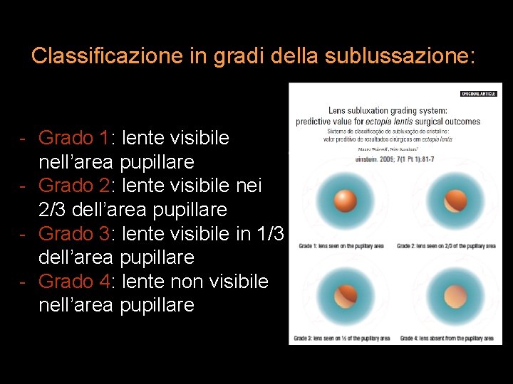 Classificazione in gradi della sublussazione: - Grado 1: lente visibile nell’area pupillare - Grado