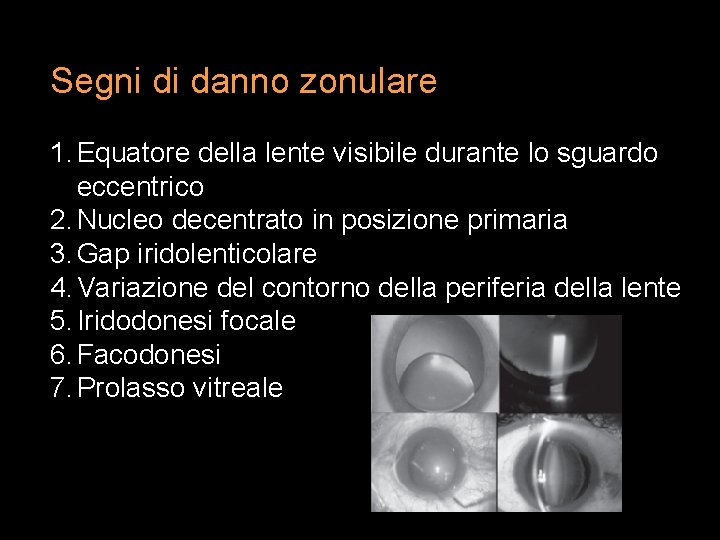 Segni di danno zonulare 1. Equatore della lente visibile durante lo sguardo eccentrico 2.