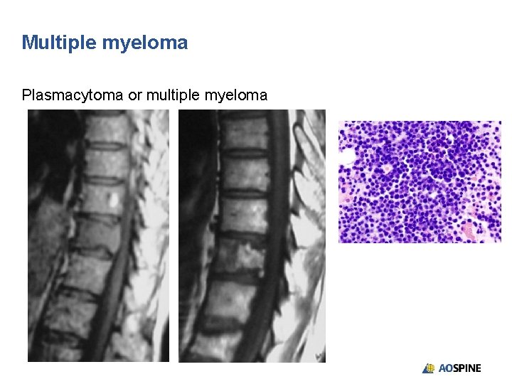 Multiple myeloma Plasmacytoma or multiple myeloma 