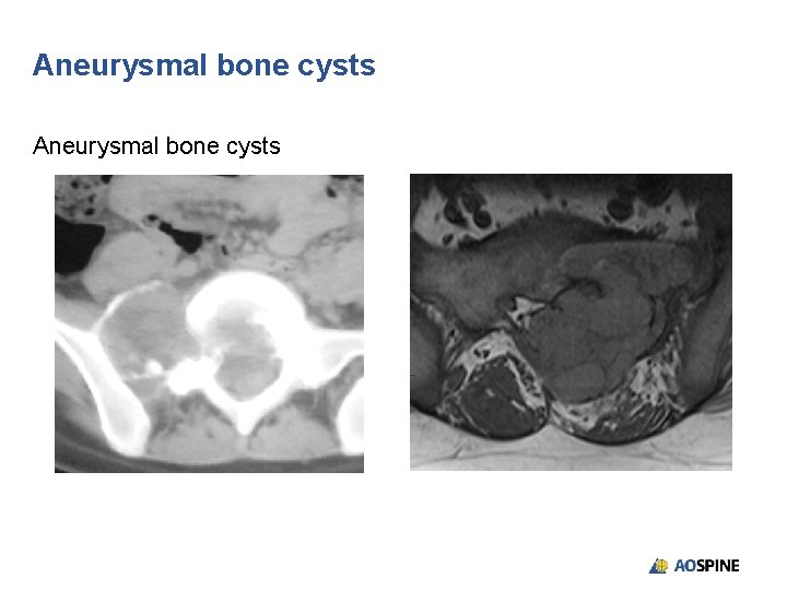 Aneurysmal bone cysts 