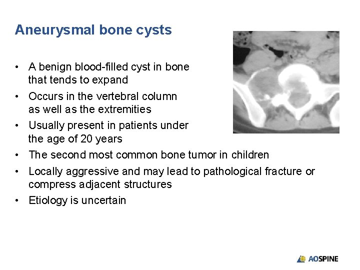 Aneurysmal bone cysts • A benign blood-filled cyst in bone that tends to expand