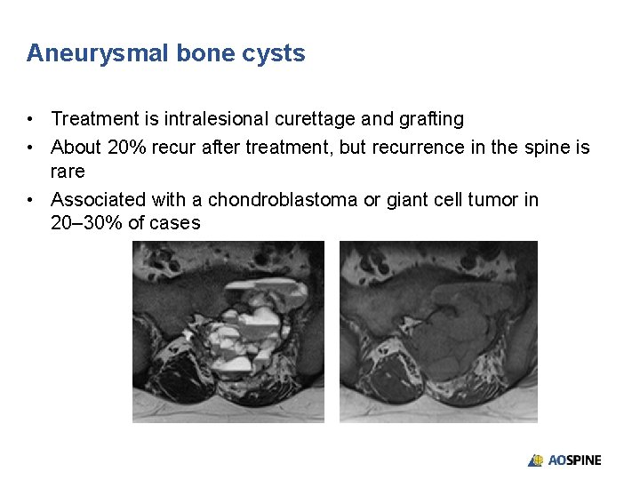 Aneurysmal bone cysts • Treatment is intralesional curettage and grafting • About 20% recur