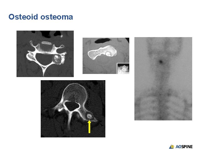 Osteoid osteoma 