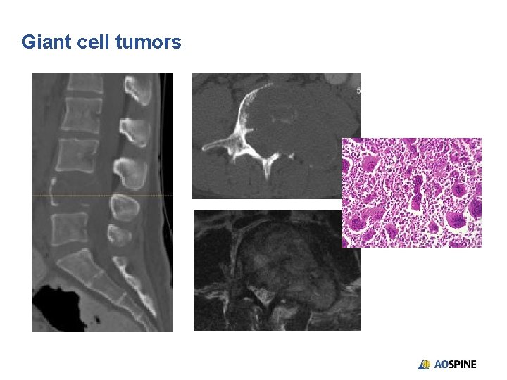 Giant cell tumors 