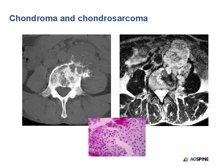 Chondroma and chondrosarcoma 