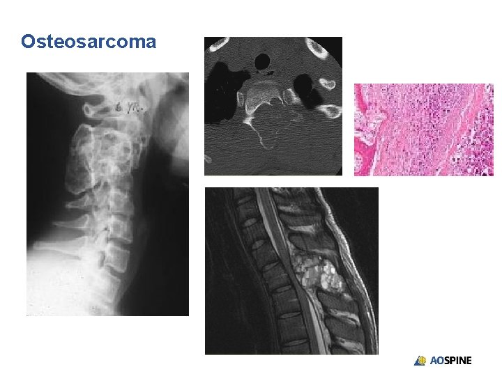 Osteosarcoma 