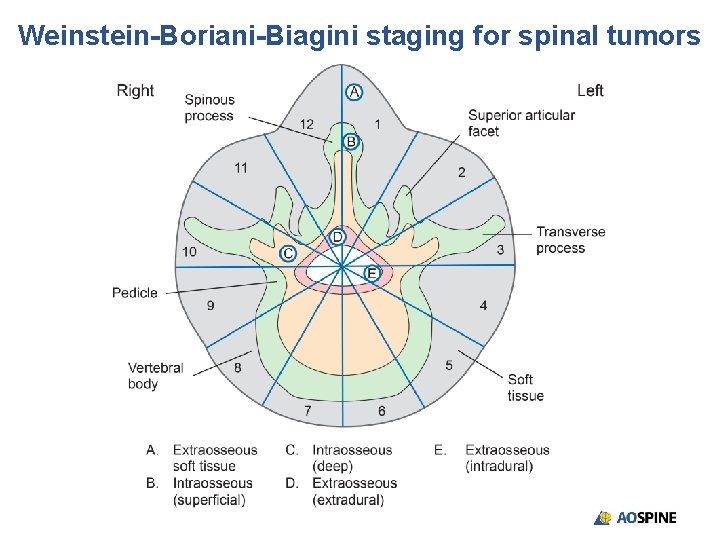 Weinstein-Boriani-Biagini staging for spinal tumors 