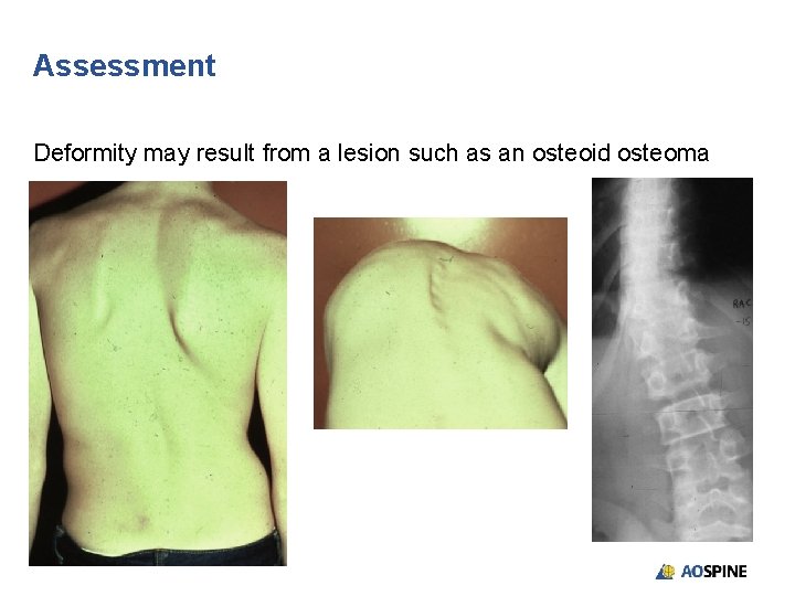 Assessment Deformity may result from a lesion such as an osteoid osteoma 
