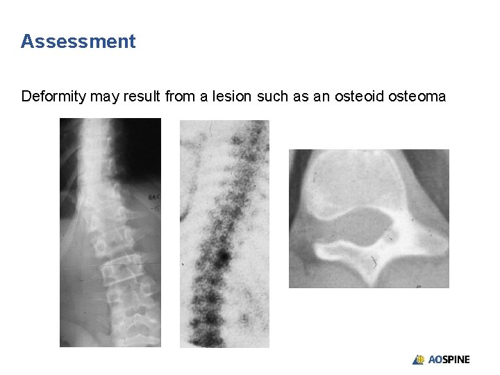 Assessment Deformity may result from a lesion such as an osteoid osteoma 