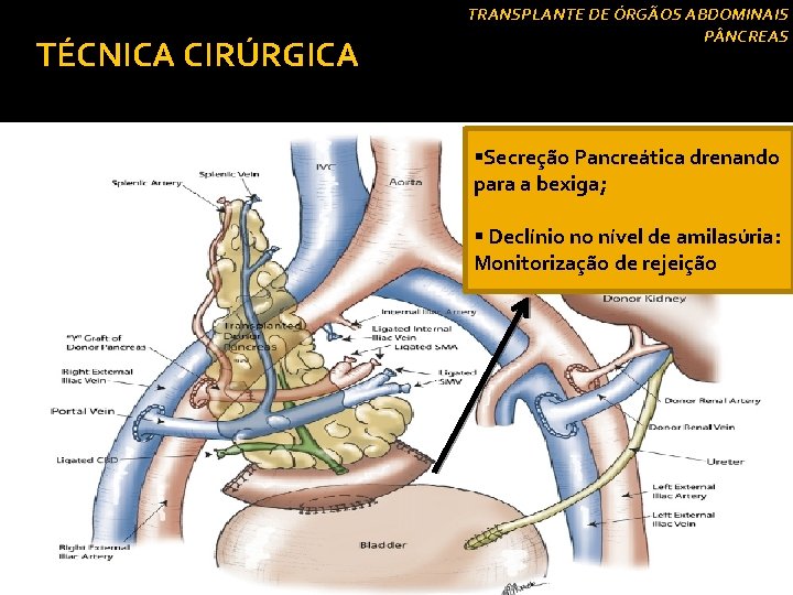 TÉCNICA CIRÚRGICA Drenagem exócrina § Drenagem vesical: TRANSPLANTE DE ÓRGÃOS ABDOMINAIS P NCREAS §Secreção