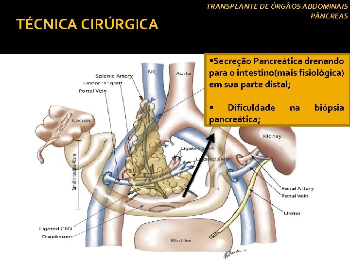 TÉCNICA CIRÚRGICA Drenagem exócrina § Drenagem entérica: TRANSPLANTE DE ÓRGÃOS ABDOMINAIS P NCREAS §Secreção