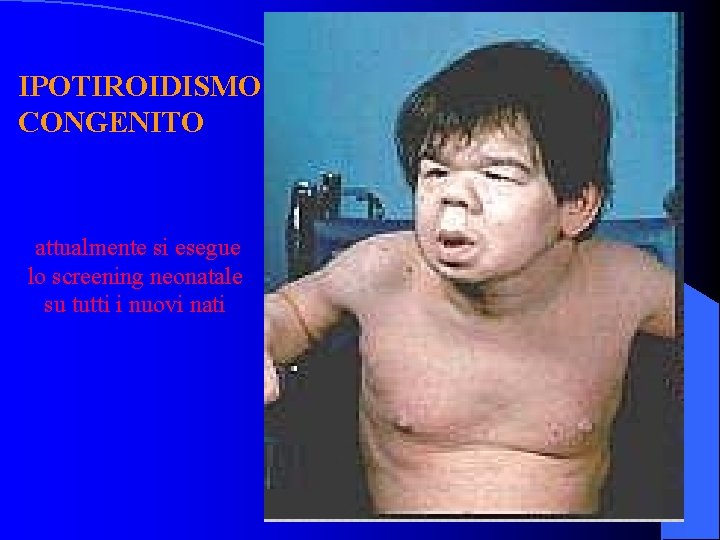 IPOTIROIDISMO CONGENITO attualmente si esegue lo screening neonatale su tutti i nuovi nati 