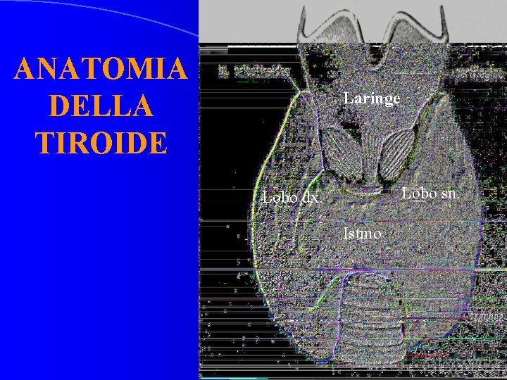 ANATOMIA DELLA TIROIDE Laringe Lobo sn. Lobo dx. Istmo 