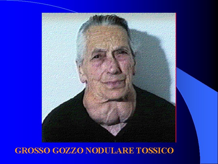 GROSSO GOZZO NODULARE TOSSICO 