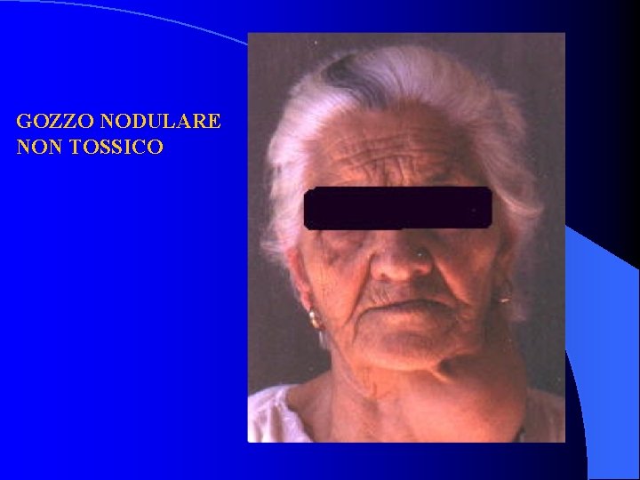 GOZZO NODULARE NON TOSSICO 