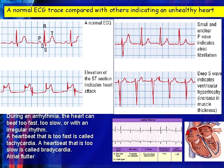 A normal ECG trace compared with others indicating an unhealthy heart During an arrhythmia,