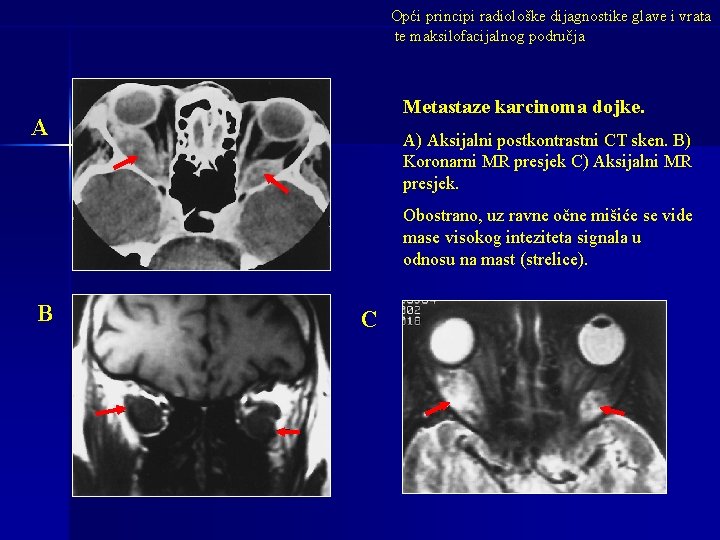 Opći principi radiološke dijagnostike glave i vrata te maksilofacijalnog područja Metastaze karcinoma dojke. A