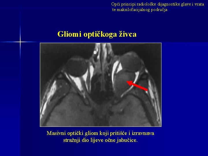 Opći principi radiološke dijagnostike glave i vrata te maksilofacijalnog područja Gliomi optičkoga živca Masivni