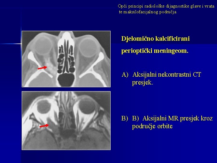 Opći principi radiološke dijagnostike glave i vrata te maksilofacijalnog područja Djelomično kalcificirani perioptički meningeom.