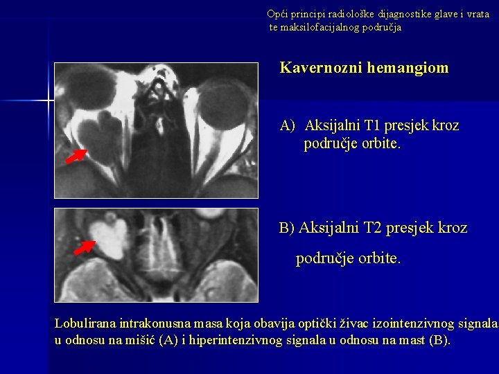 Opći principi radiološke dijagnostike glave i vrata te maksilofacijalnog područja Kavernozni hemangiom A) Aksijalni