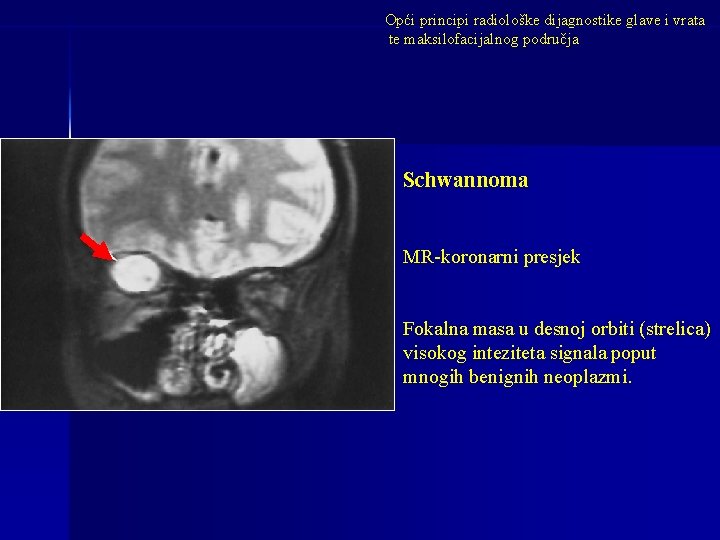 Opći principi radiološke dijagnostike glave i vrata te maksilofacijalnog područja Schwannoma MR-koronarni presjek Fokalna