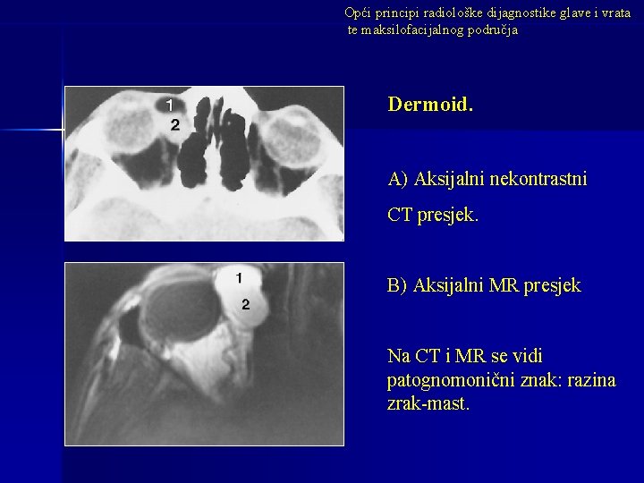 Opći principi radiološke dijagnostike glave i vrata te maksilofacijalnog područja Dermoid. A) Aksijalni nekontrastni