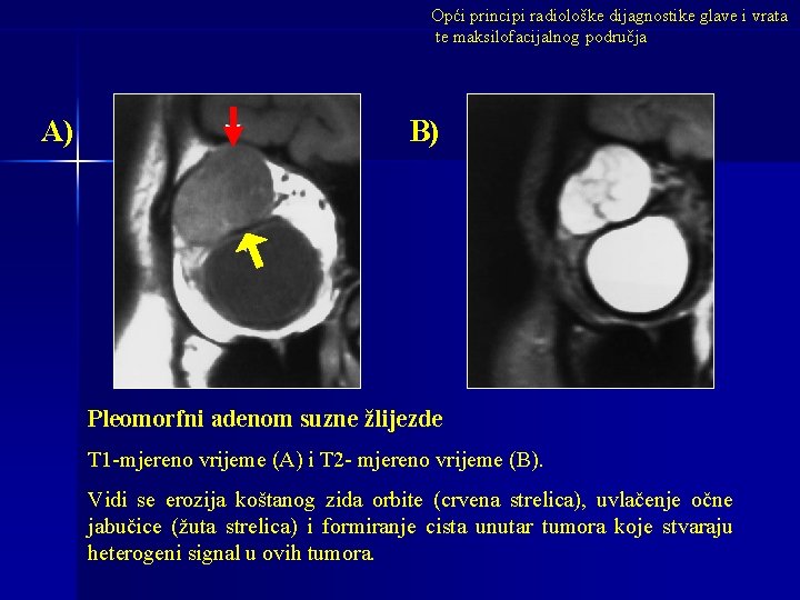 Opći principi radiološke dijagnostike glave i vrata te maksilofacijalnog područja A) B) Pleomorfni adenom