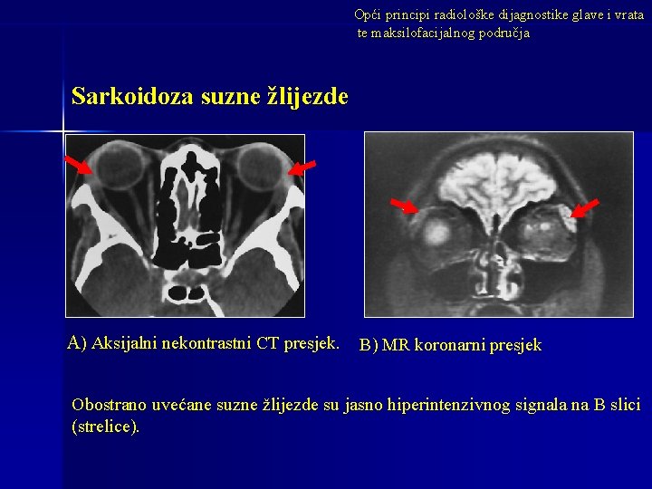 Opći principi radiološke dijagnostike glave i vrata te maksilofacijalnog područja Sarkoidoza suzne žlijezde A)