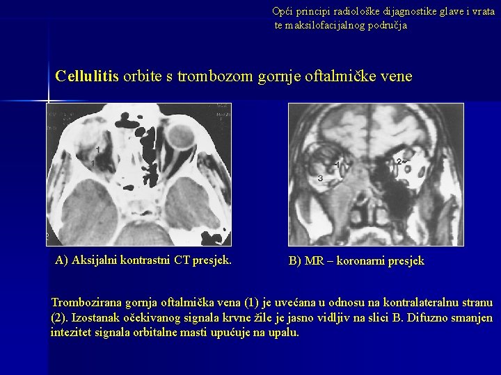 Opći principi radiološke dijagnostike glave i vrata te maksilofacijalnog područja Cellulitis orbite s trombozom