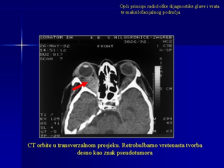 Opći principi radiološke dijagnostike glave i vrata te maksilofacijalnog područja CT orbite u transverzalnom