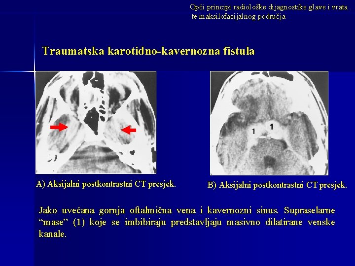 Opći principi radiološke dijagnostike glave i vrata te maksilofacijalnog područja Traumatska karotidno-kavernozna fistula A)