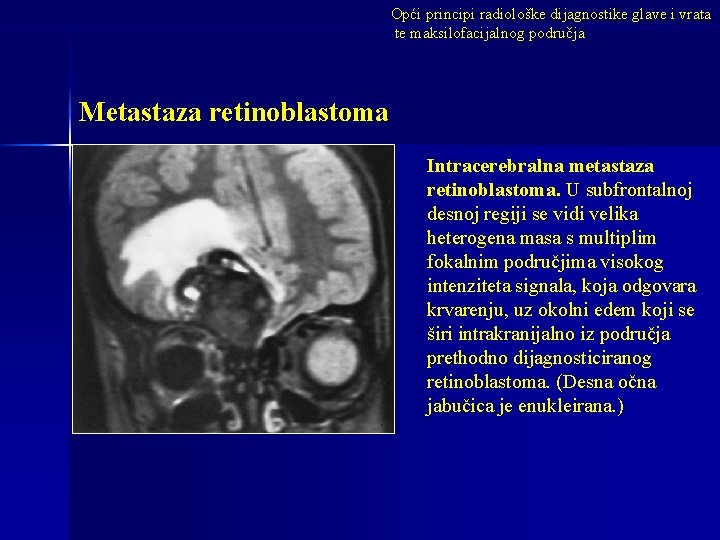 Opći principi radiološke dijagnostike glave i vrata te maksilofacijalnog područja Metastaza retinoblastoma Intracerebralna metastaza