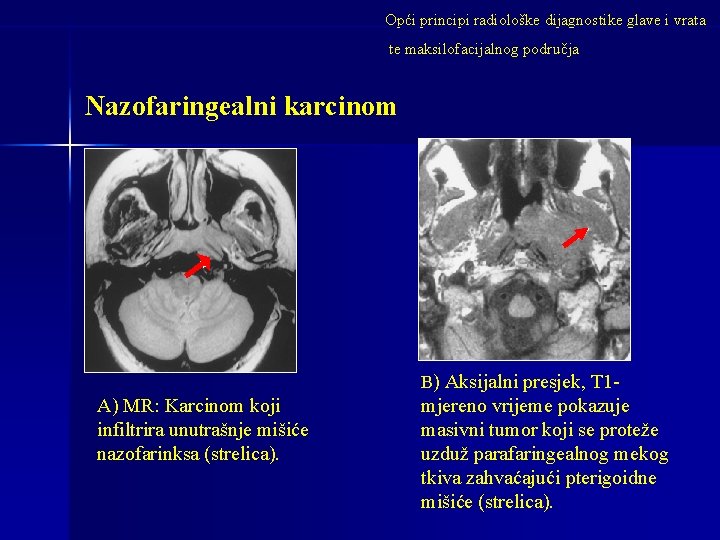 Opći principi radiološke dijagnostike glave i vrata te maksilofacijalnog područja Nazofaringealni karcinom B) Aksijalni