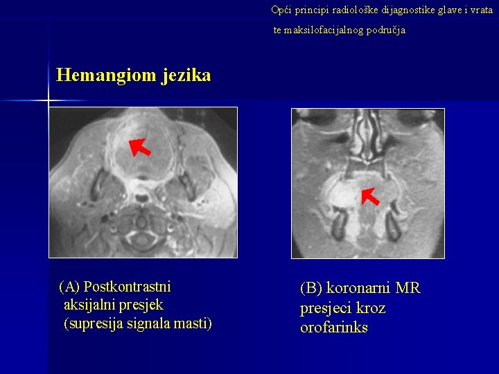 Opći principi radiološke dijagnostike glave i vrata te maksilofacijalnog područja Hemangiom jezika (A) Postkontrastni