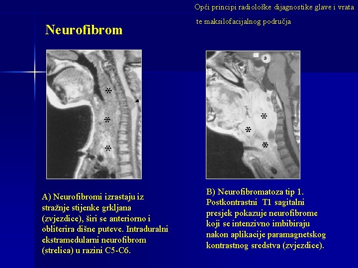 Opći principi radiološke dijagnostike glave i vrata Neurofibrom A) Neurofibromi izrastaju iz stražnje stijenke