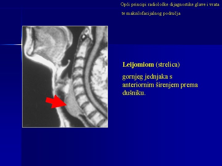 Opći principi radiološke dijagnostike glave i vrata te maksilofacijalnog područja Leijomiom (strelica) gornjeg jednjaka