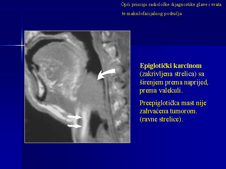 Opći principi radiološke dijagnostike glave i vrata te maksilofacijalnog područja Epiglotički karcinom (zakrivljena strelica)