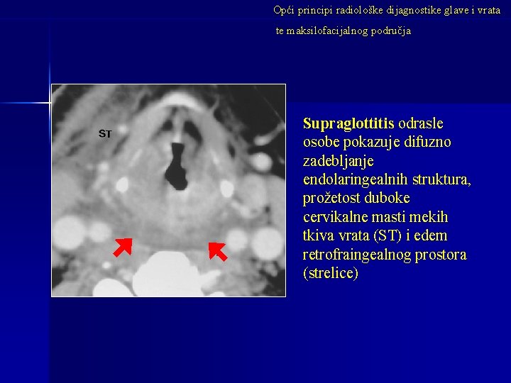 Opći principi radiološke dijagnostike glave i vrata te maksilofacijalnog područja Supraglottitis odrasle osobe pokazuje