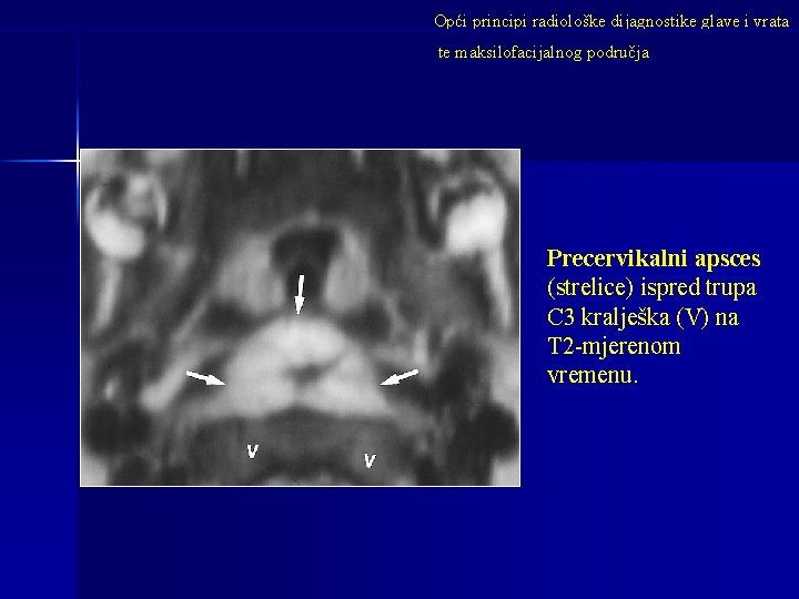 Opći principi radiološke dijagnostike glave i vrata te maksilofacijalnog područja Precervikalni apsces (strelice) ispred