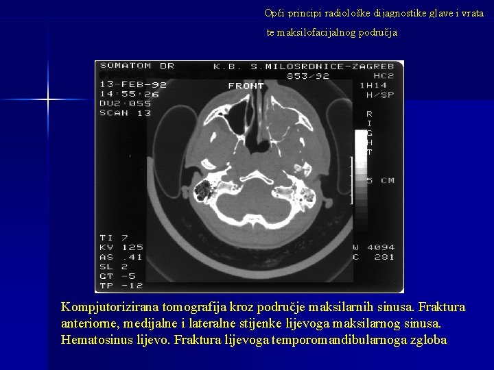 Opći principi radiološke dijagnostike glave i vrata te maksilofacijalnog područja Kompjutorizirana tomografija kroz područje