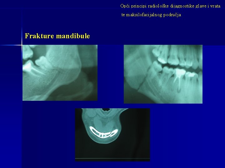 Opći principi radiološke dijagnostike glave i vrata te maksilofacijalnog područja Frakture mandibule 