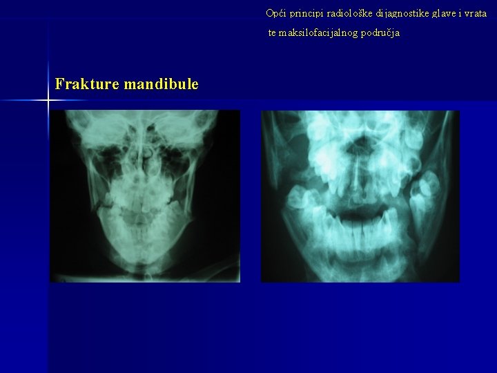 Opći principi radiološke dijagnostike glave i vrata te maksilofacijalnog područja Frakture mandibule 