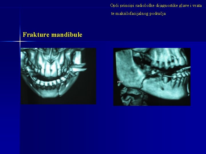 Opći principi radiološke dijagnostike glave i vrata te maksilofacijalnog područja Frakture mandibule 