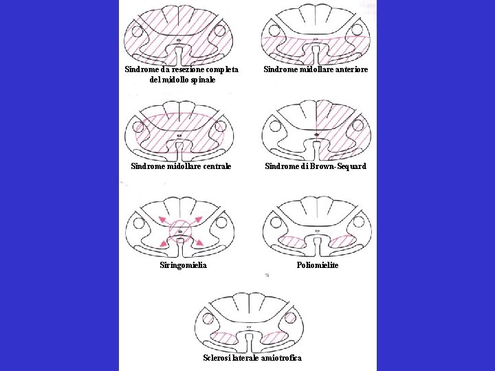 Sindrome da resezione completa del midollo spinale Sindrome midollare anteriore Sindrome midollare centrale Sindrome Sindrome da resezione completa del midollo spinale Sindrome midollare anteriore Sindrome midollare centrale Sindrome