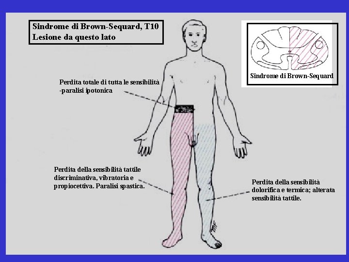 Sindrome di Brown-Sequard, T 10 Lesione da questo lato Perdita totale di tutta le Sindrome di Brown-Sequard, T 10 Lesione da questo lato Perdita totale di tutta le