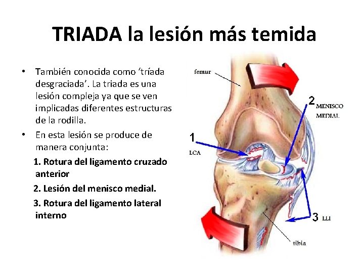 TRIADA la lesión más temida • También conocida como ‘tríada desgraciada’. La triada es